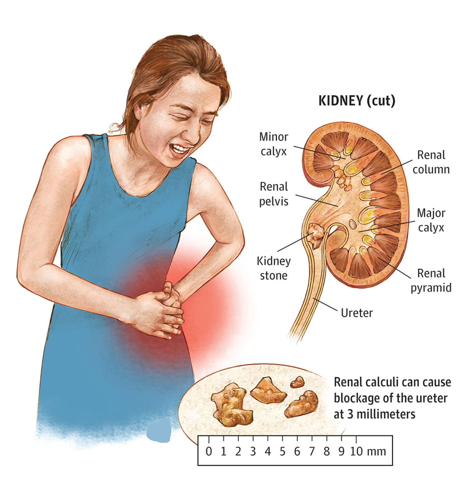 kidney-stone-remedy.jpg